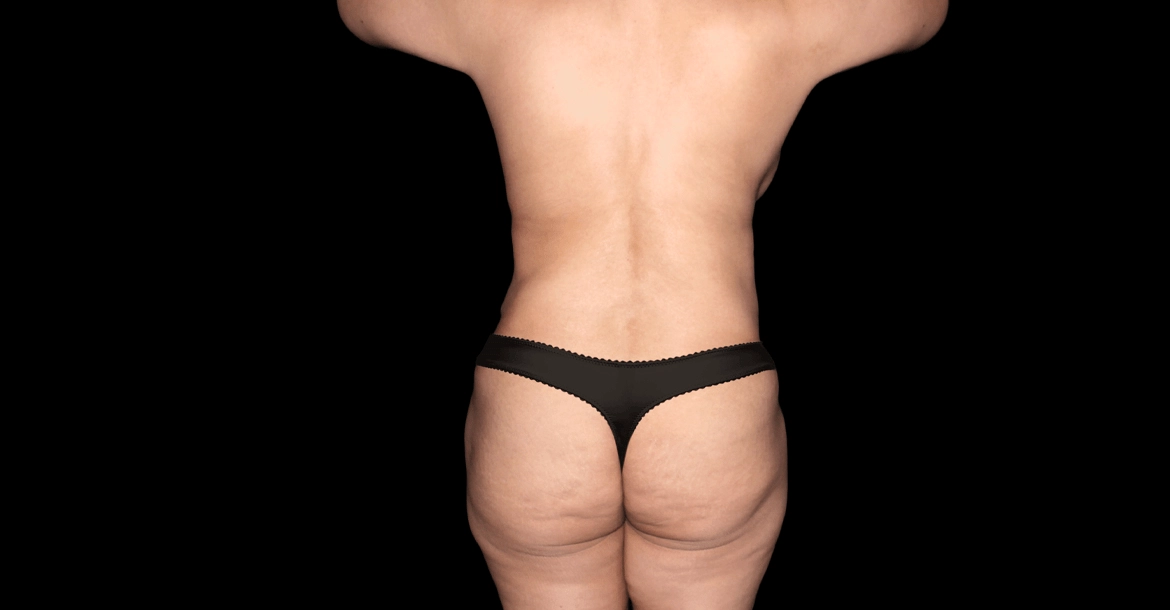 13018 Brazilian Butt Lift, Liposuction (thighs) before web 1