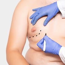 Male Breast Surgery