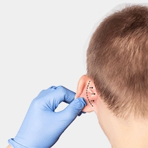 Otoplasty