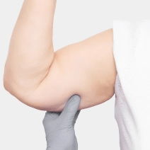 Brachioplasty