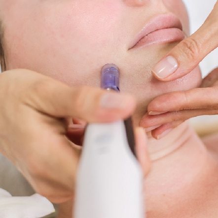 Microneedling
