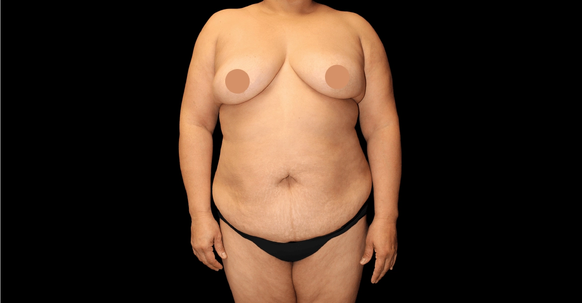 Liposuction 360