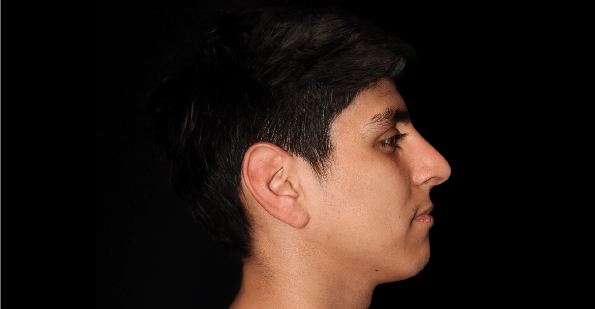 Rhinoplasty