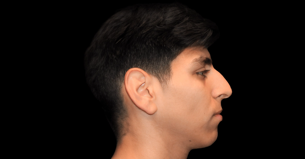 Rhinoplasty