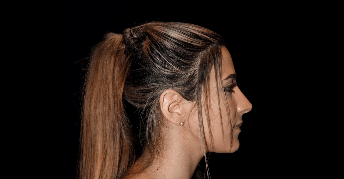 Rhinoplasty
