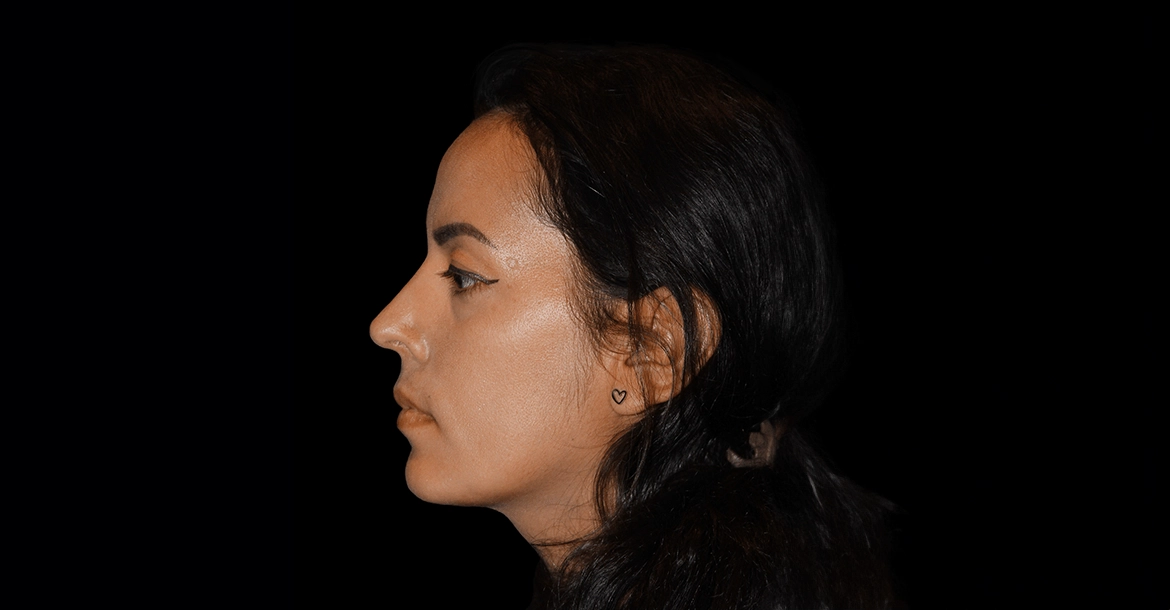 Rhinoplasty
