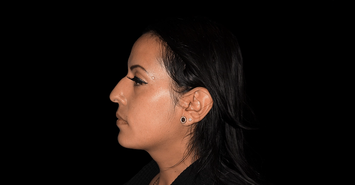 Rhinoplasty