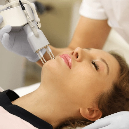 Acupulse laser