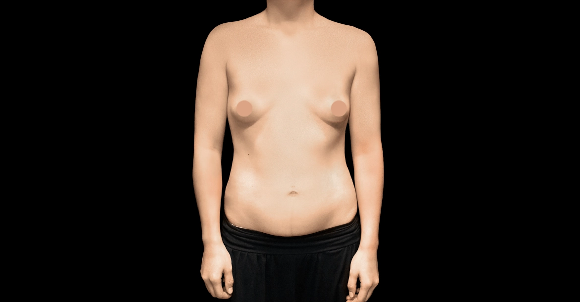 Breast Augmentation