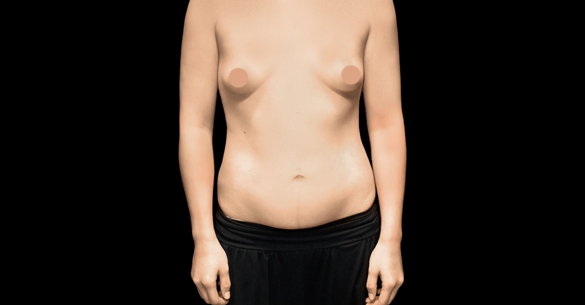 Breast Augmentation