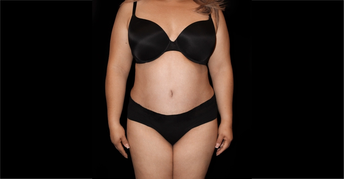 Tummy Tuck