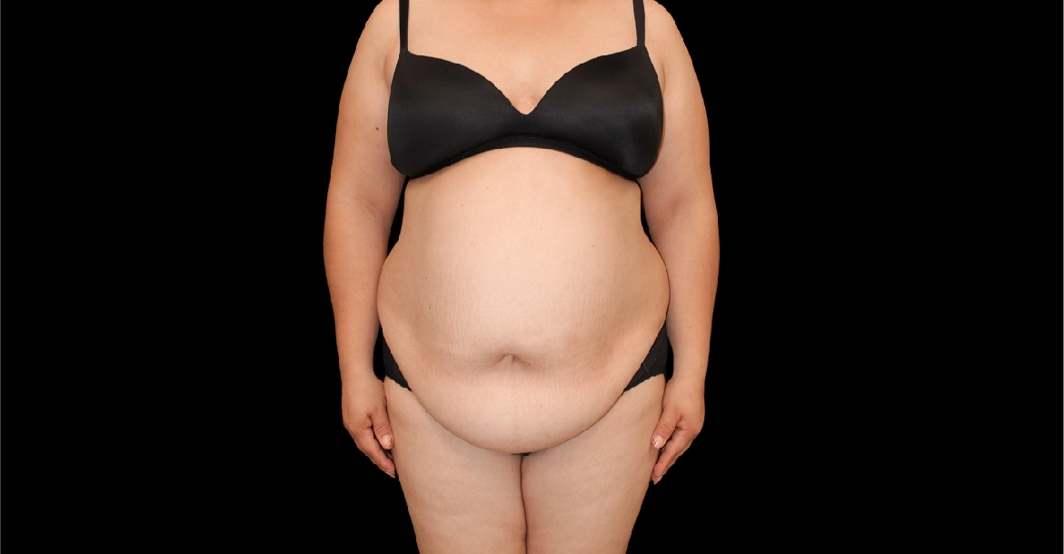 Tummy Tuck