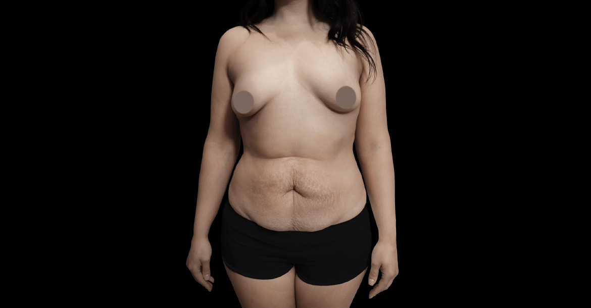 Tummy Tuck After