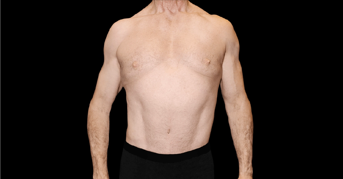 Tummy Tuck After