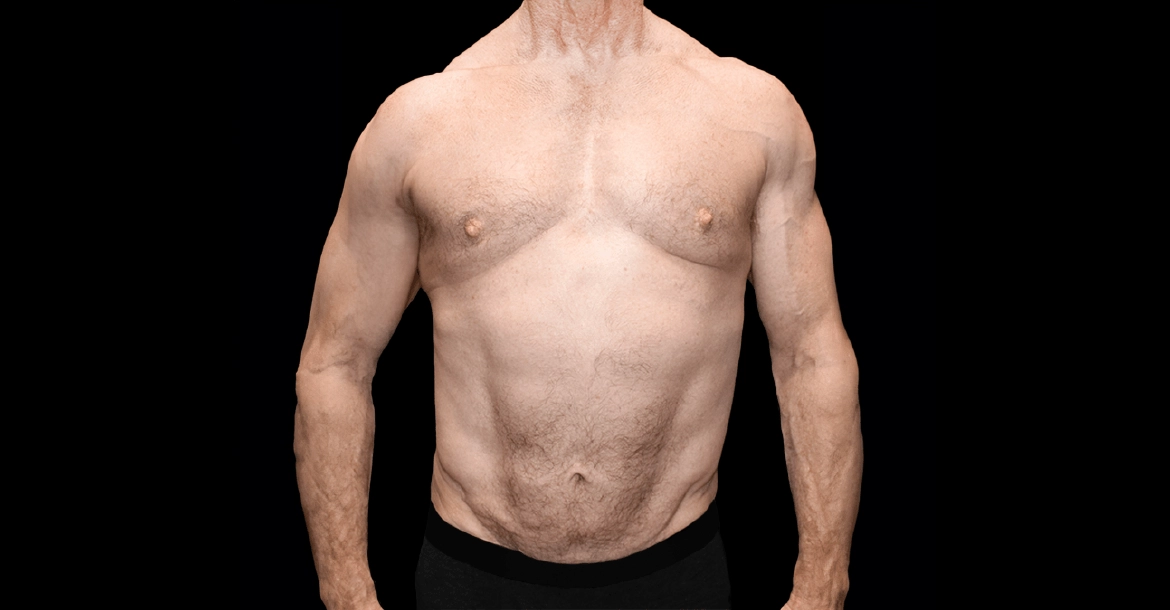 Tummy Tuck After