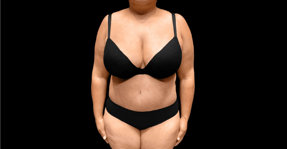 Tummy Tuck After