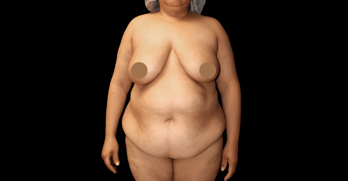 Tummy Tuck After