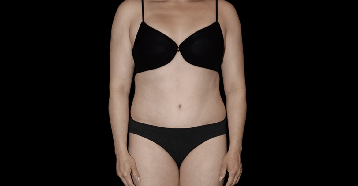 Abdominoplasty