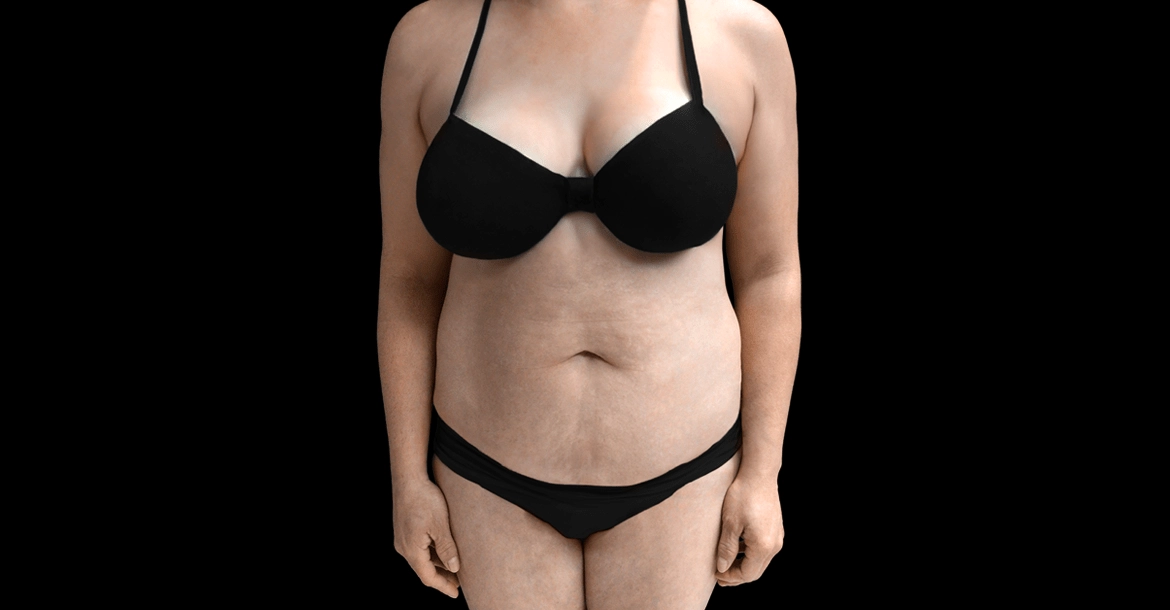 Abdominoplasty