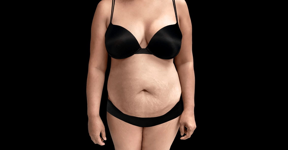 Abdominoplasty