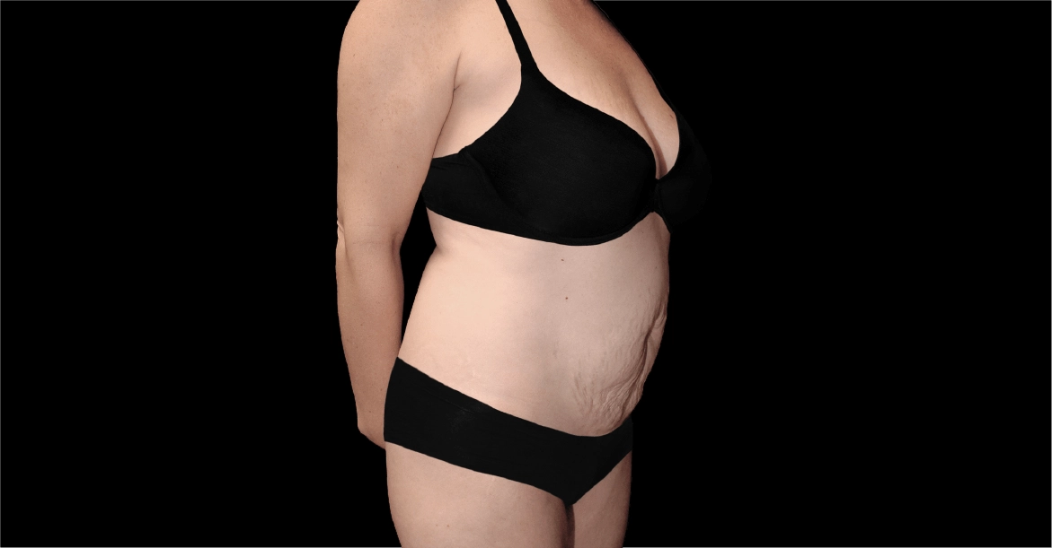 Tummy Tuck