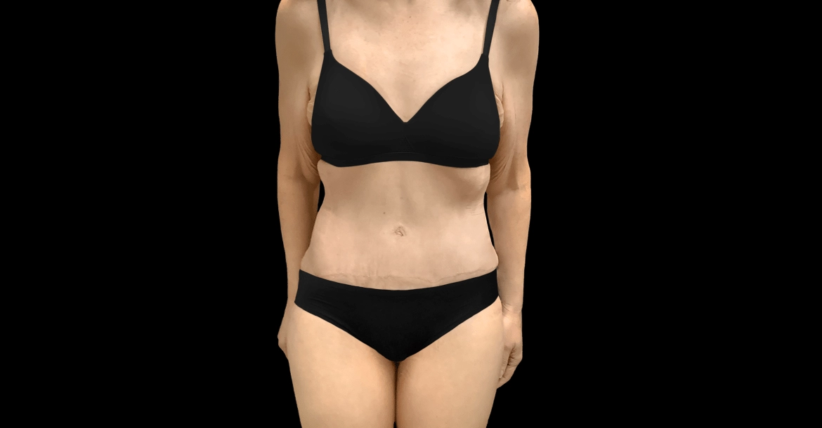 Tummy Tuck