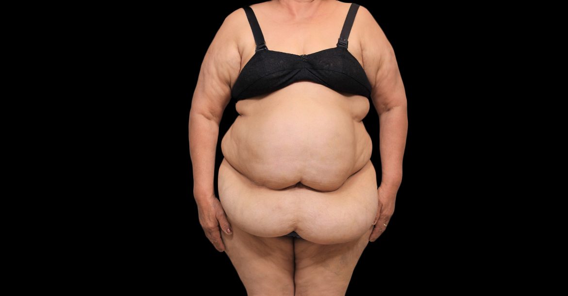 3554-Tummy-tuck-ANTES-2