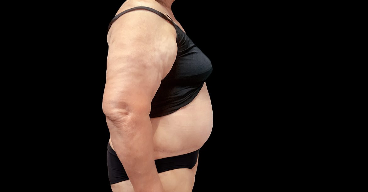Abdominoplasty