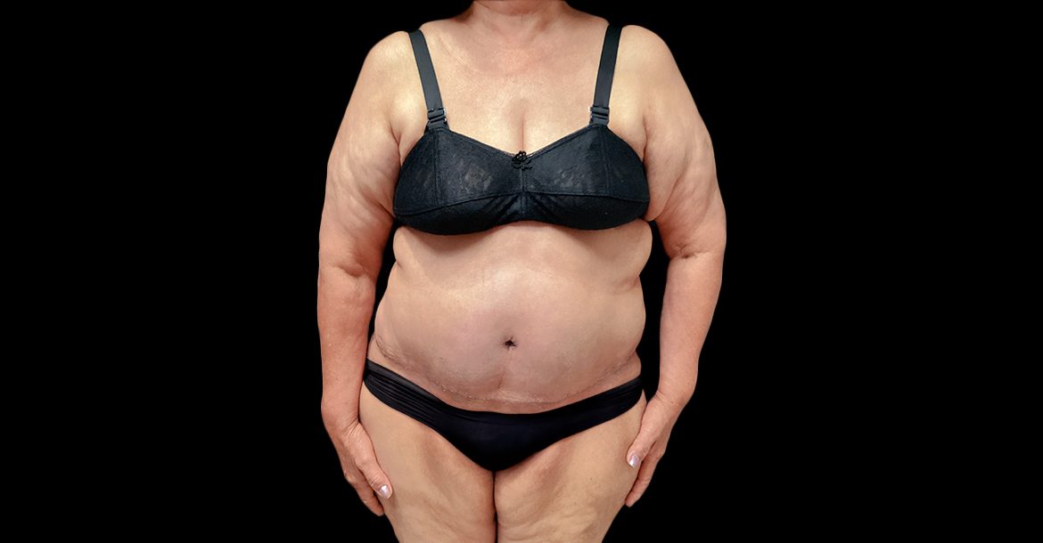 Abdominoplasty