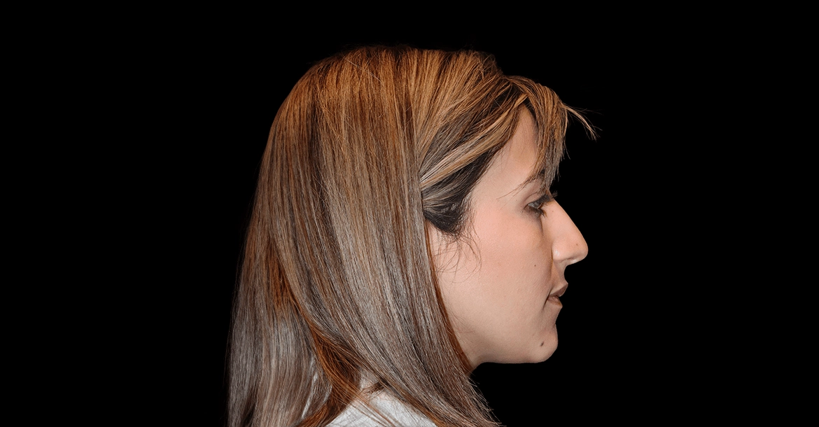 Rhinoplasty