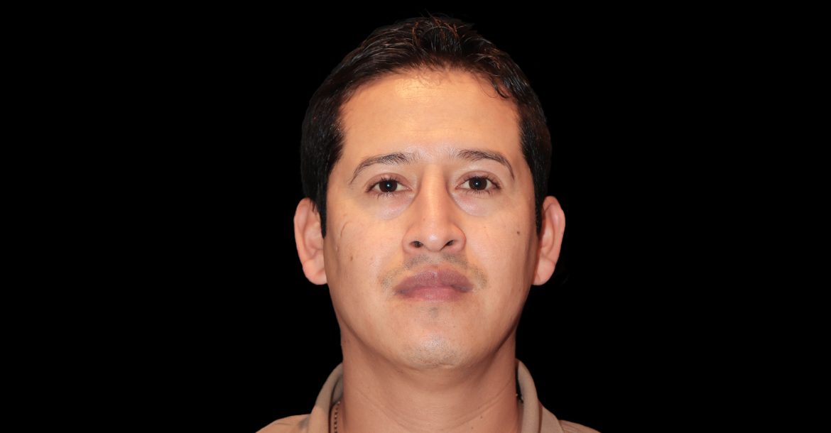 Blepharoplasty