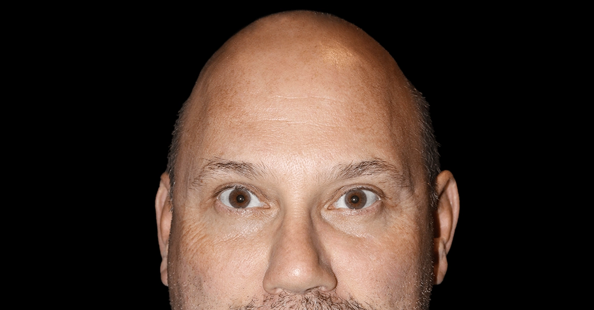 Blepharoplasty and Necklift