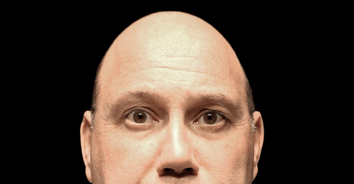 Blepharoplasty