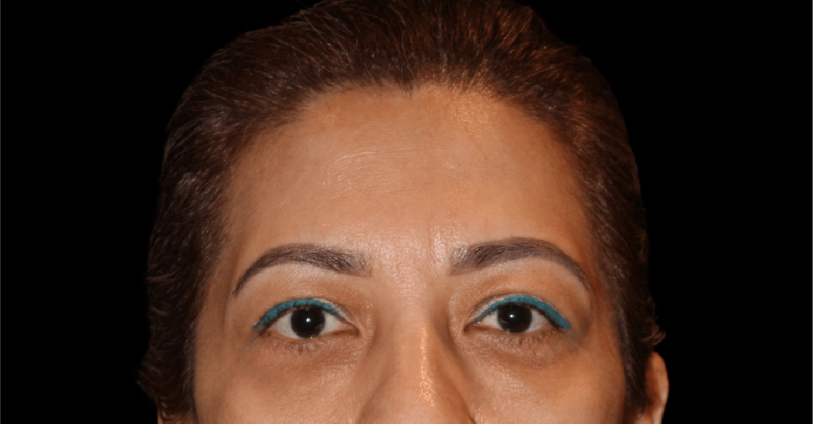 Blepharoplasty