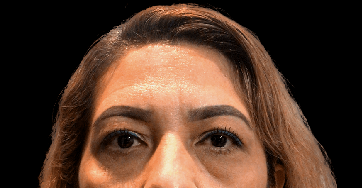 Blepharoplasty