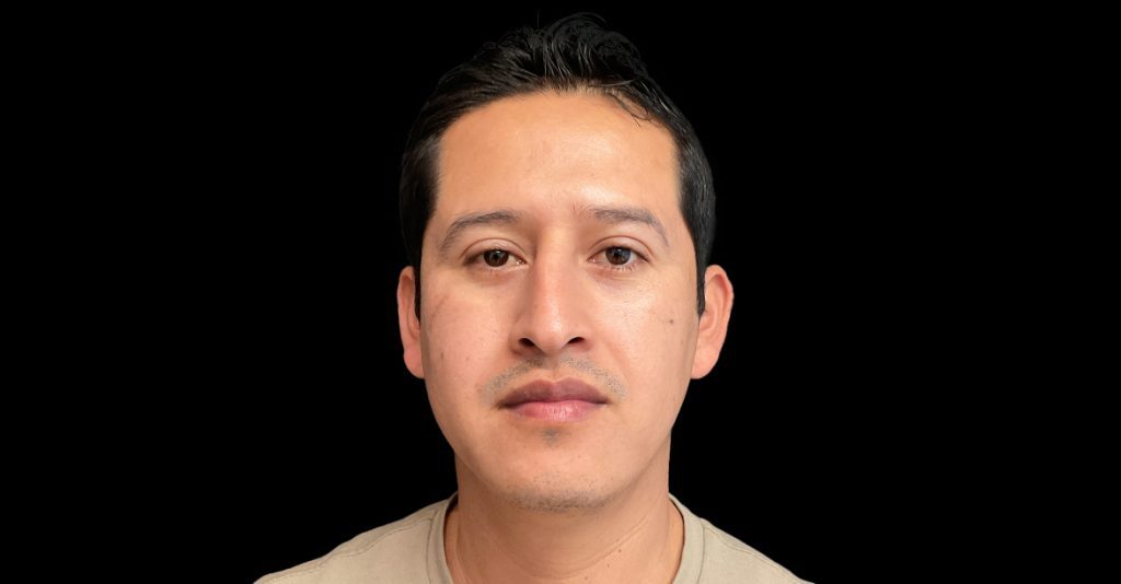 Blepharoplasty