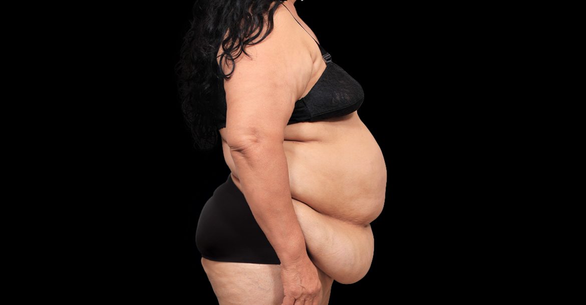 Abdominoplasty