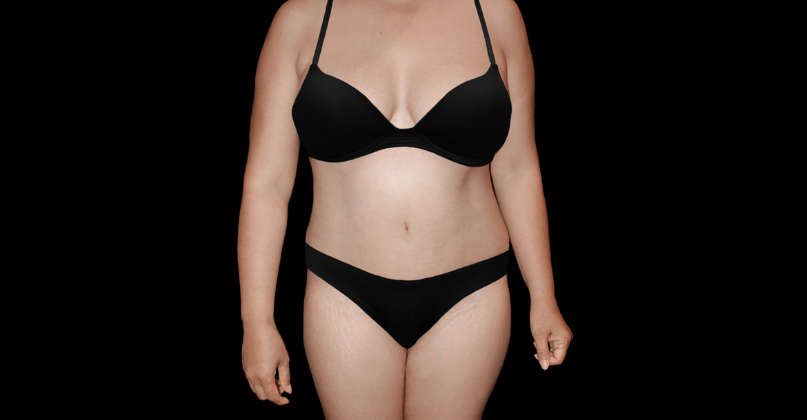 Abdominoplasty