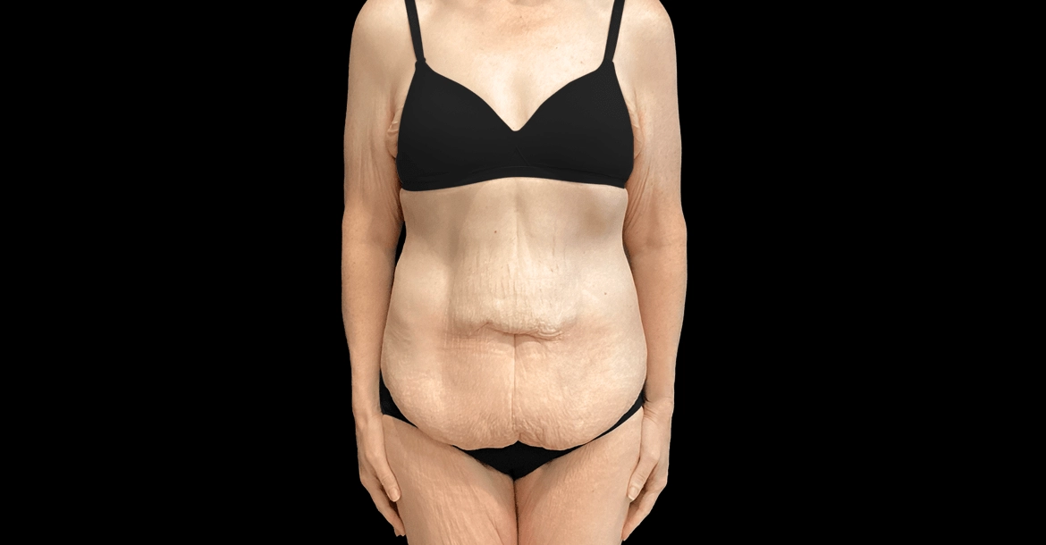 Tummy Tuck