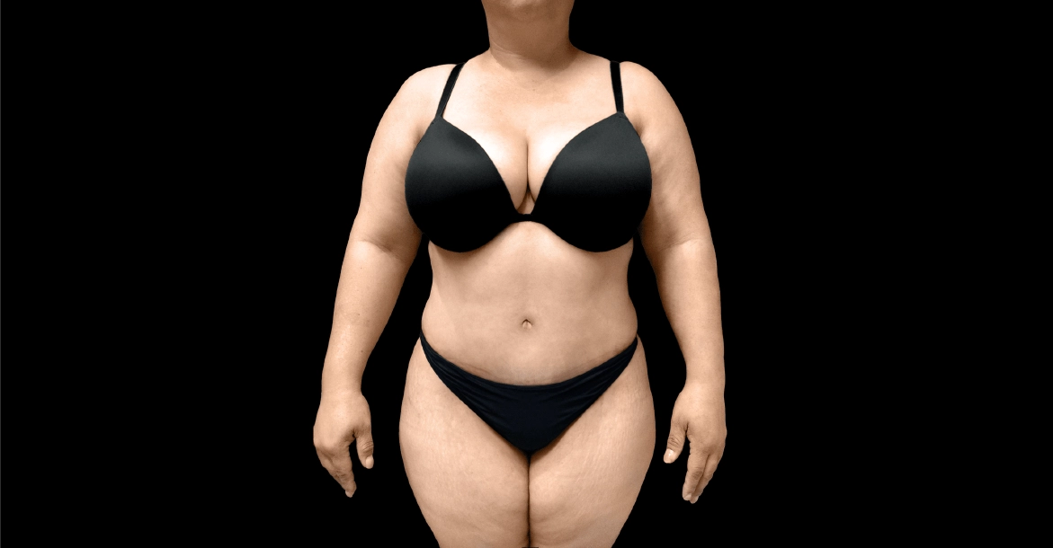 Mommy Makeover