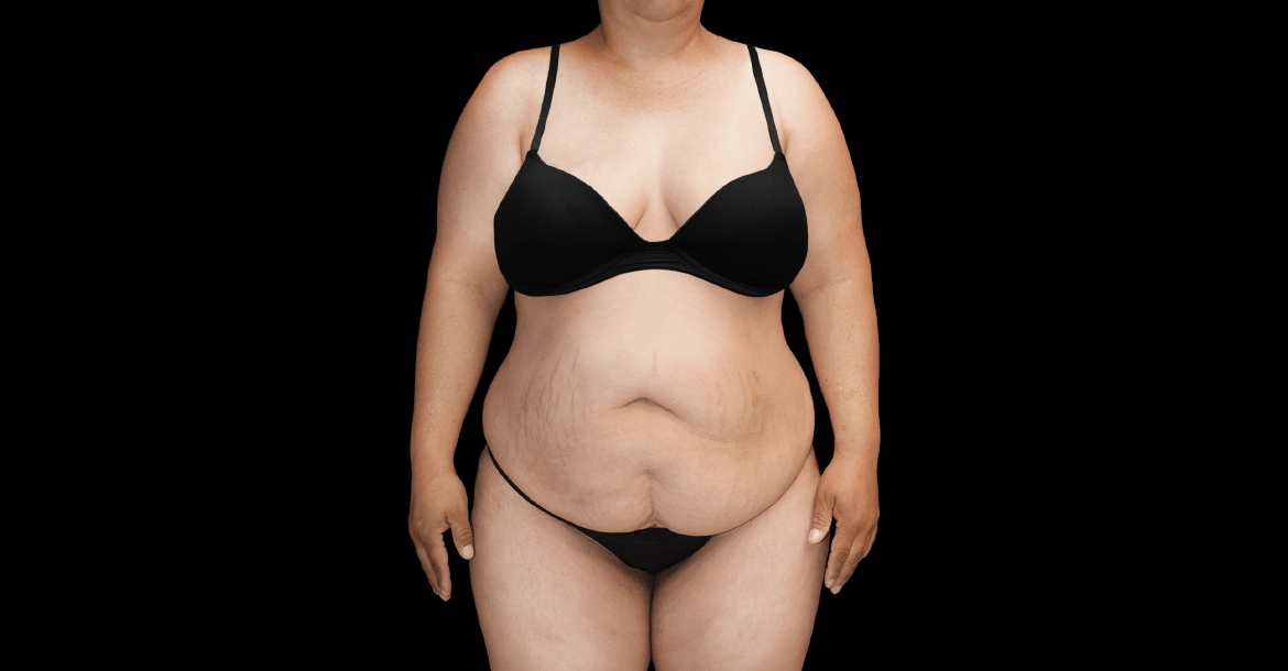 Mommy Makeover