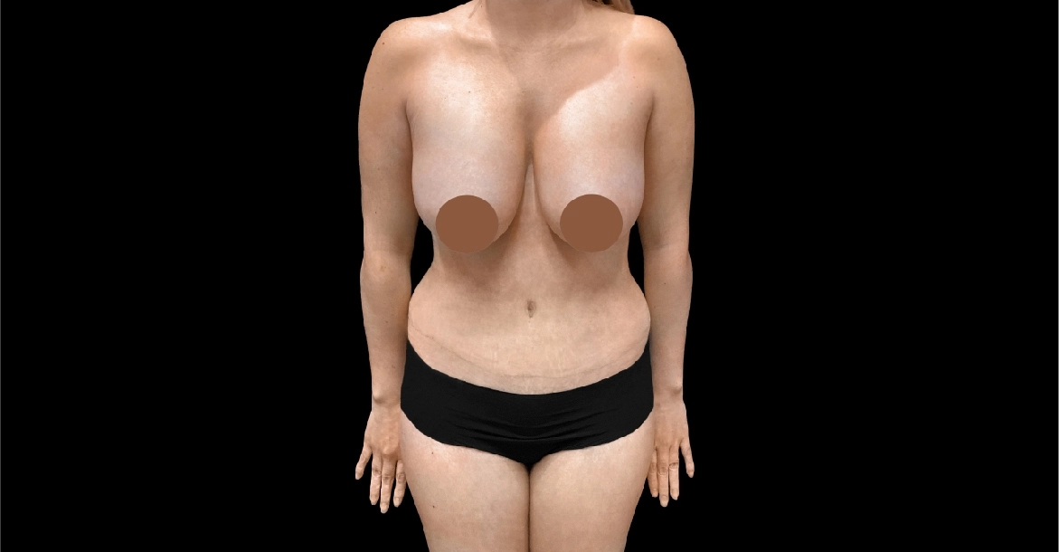 Breast Lift