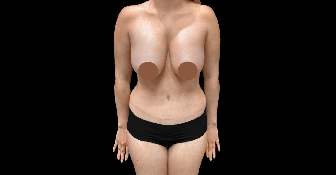 Breast Lift