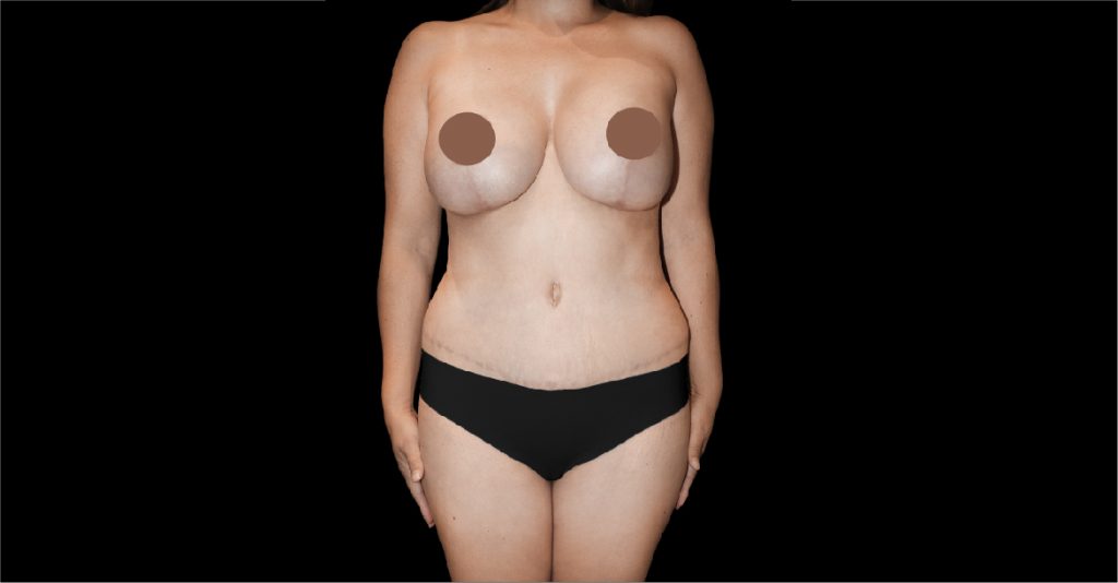 Breast Lift