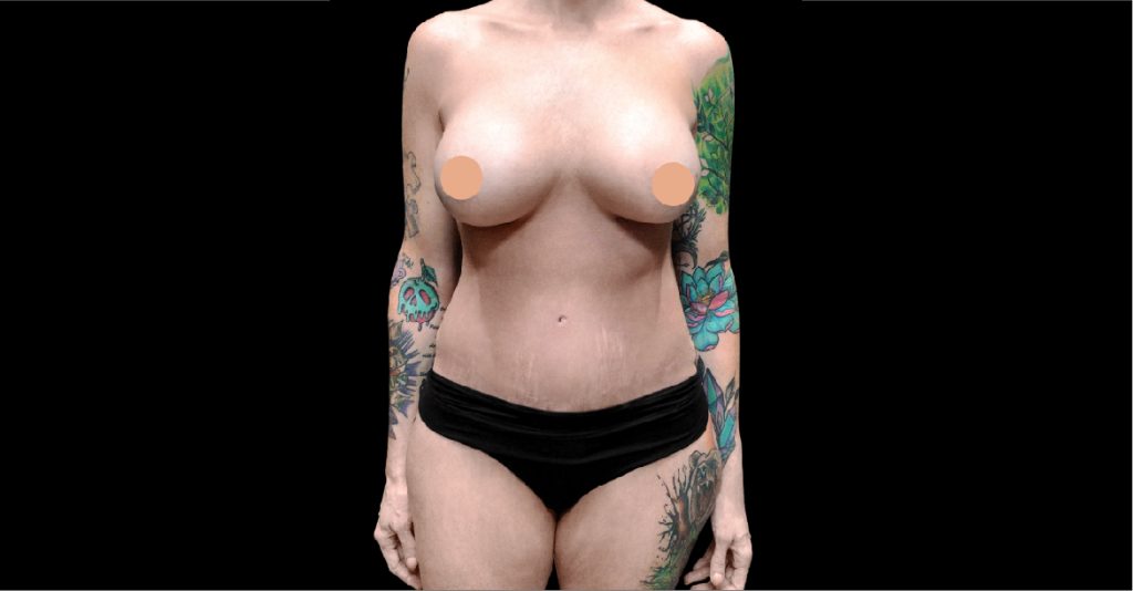 Tummy Tuck
