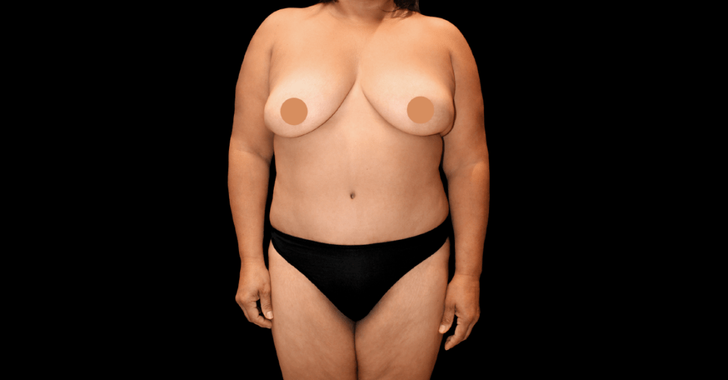 Liposuction 360