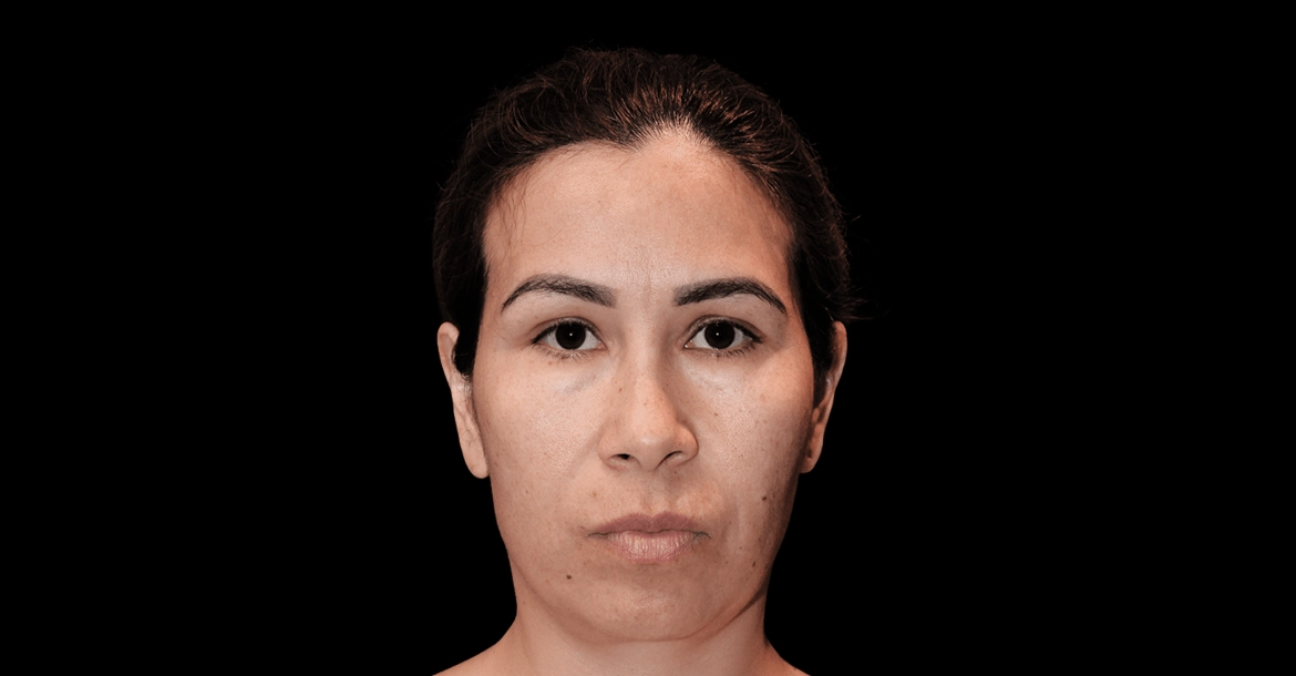 Necklift